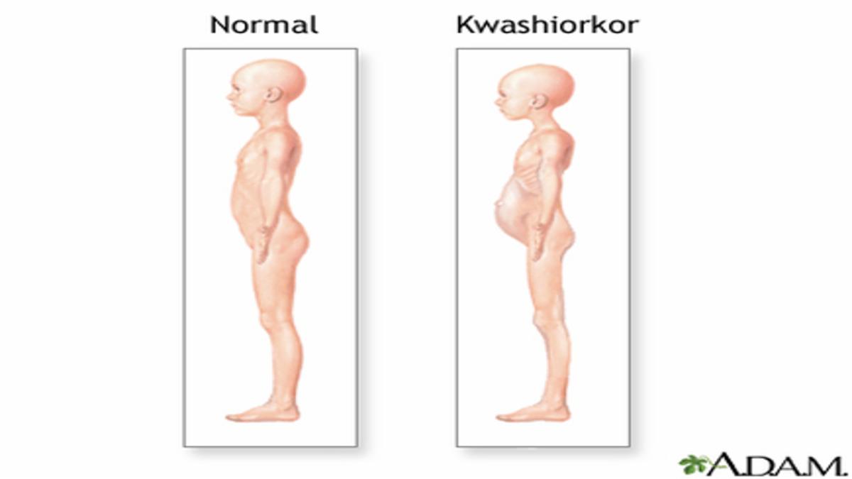 Common Weight Loss Mistakes Indians Make and How to Avoid Them | Complete Guide